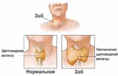 Профилактика йоддефицитных заболеваний