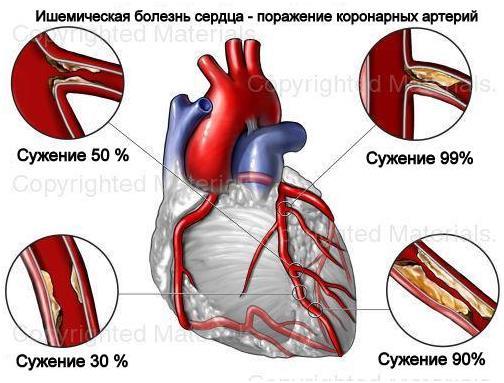 ИБС
