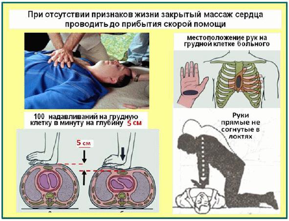 Памятка по оказанию первой помощи при внезапной коронарной смерти