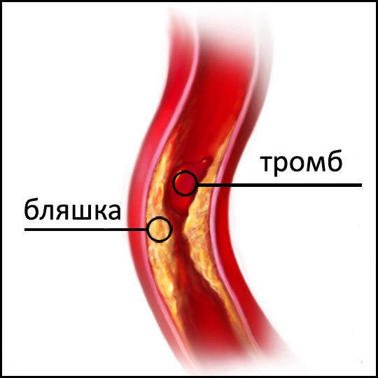 Школа профилактики атеросклероза